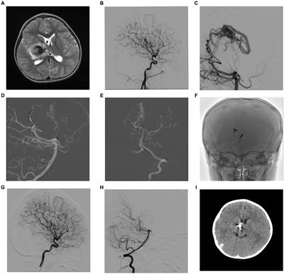 Endovascular embolization for basal ganglia and thalamic arteriovenous malformations